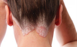 Psoriasis, get to know this disease better.